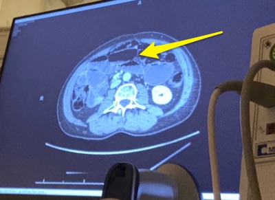 Imaging shows the location of the obstruction. Left: CT scan. Right: Frontal chest Xray shows the NG tube correctly lying at the entrance to the small intestine.